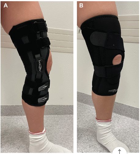 外傷性膝蓋骨外側脱臼のサポーターの種類