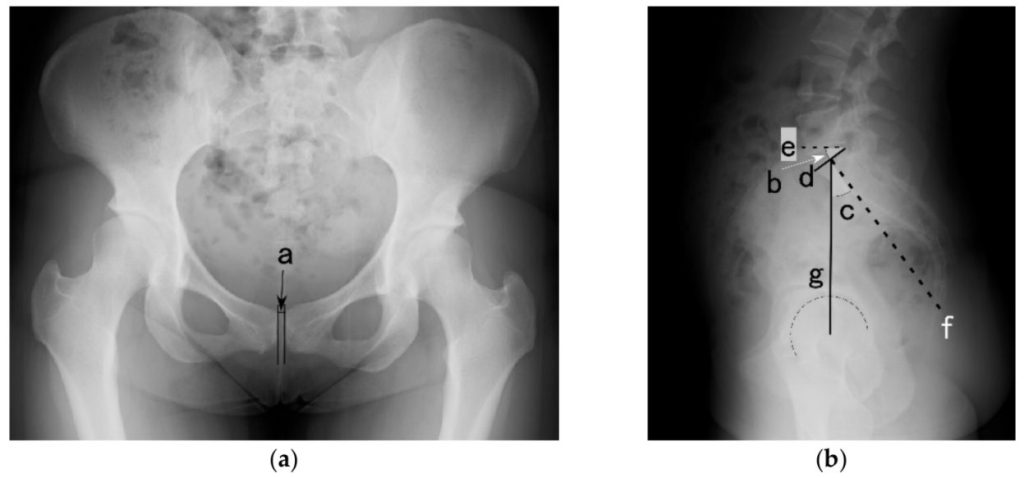 産後の腰椎と骨盤アライメントのx-ray画像